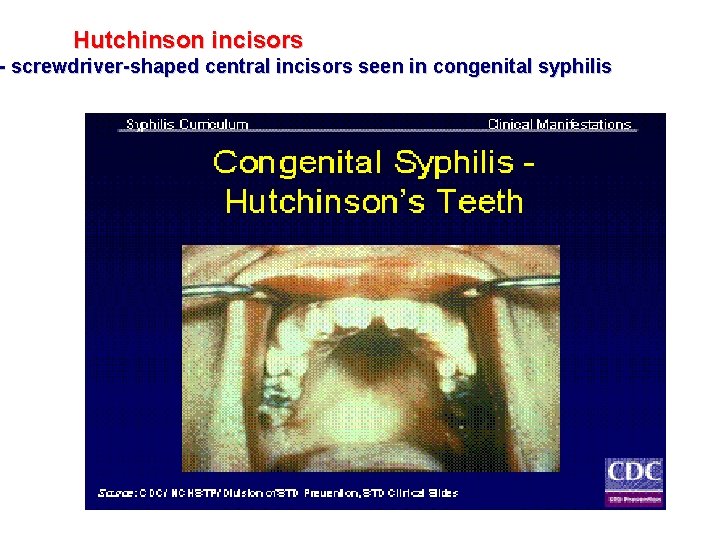 Hutchinson incisors - screwdriver-shaped central incisors seen in congenital syphilis 