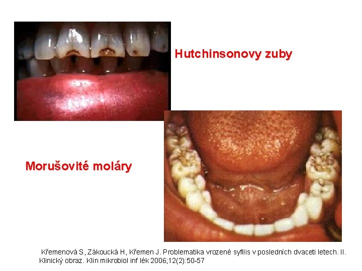 Hutchinsonovy zuby Morušovité moláry Křemenová S, Zákoucká H, Křemen J. Problematika vrozené syfilis v