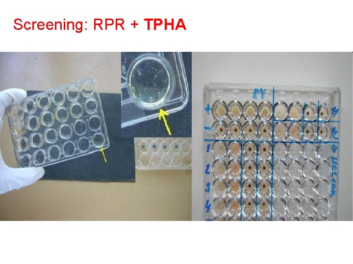 Screening: RPR + TPHA 