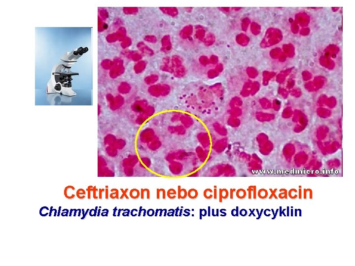 Ceftriaxon nebo ciprofloxacin Chlamydia trachomatis: plus doxycyklin 