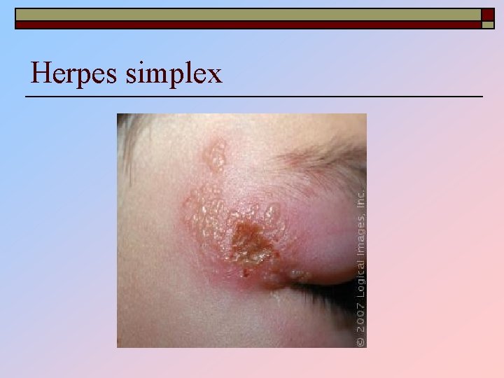 Herpes simplex 