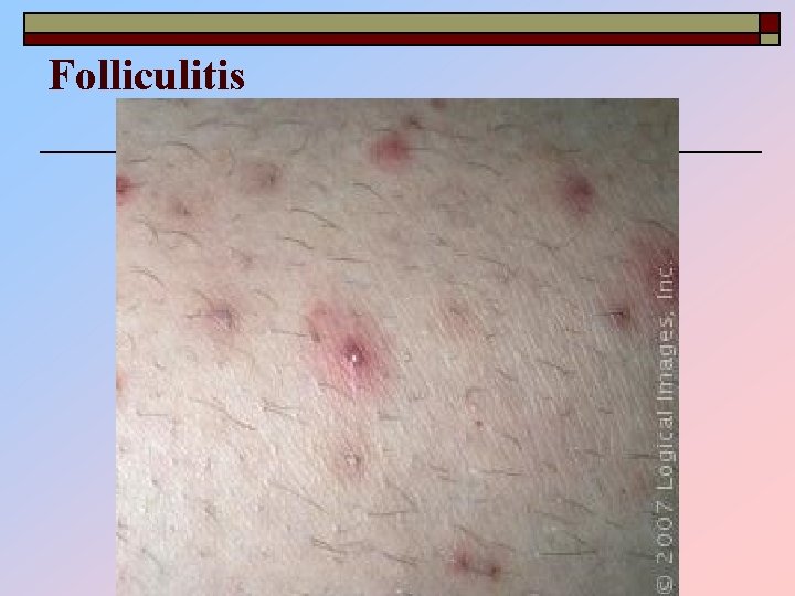 Folliculitis 
