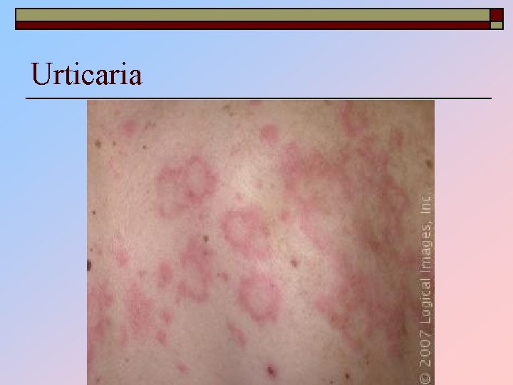 Urticaria 