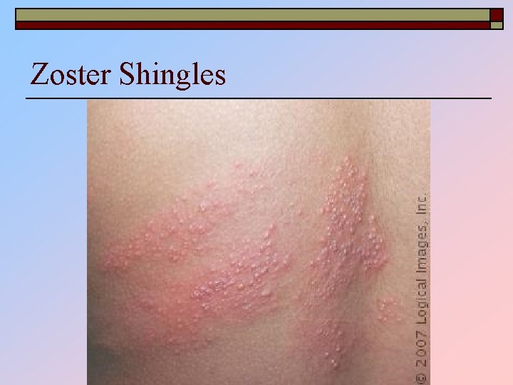 Zoster Shingles 