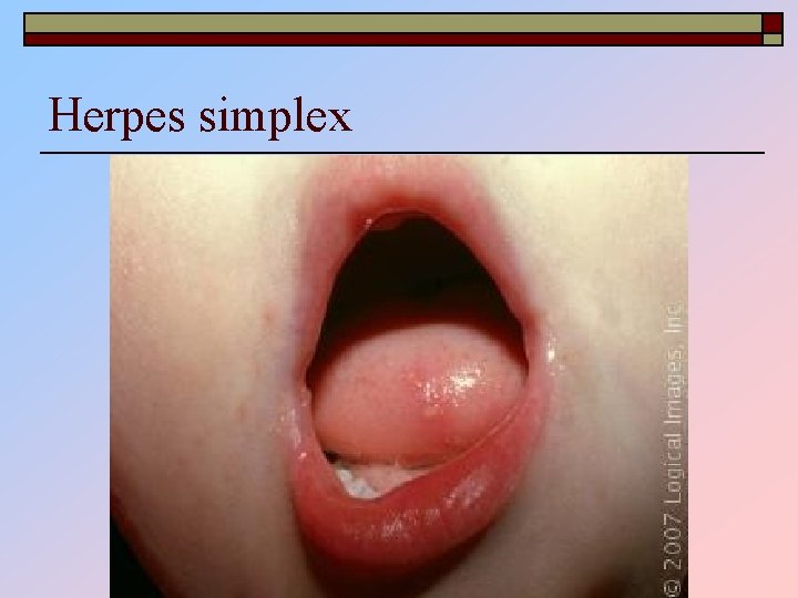 Herpes simplex 