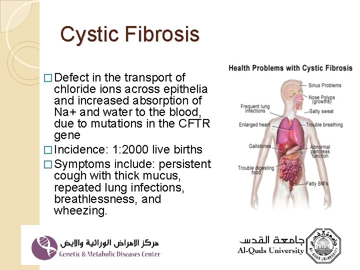 Cystic Fibrosis � Defect in the transport of chloride ions across epithelia and increased