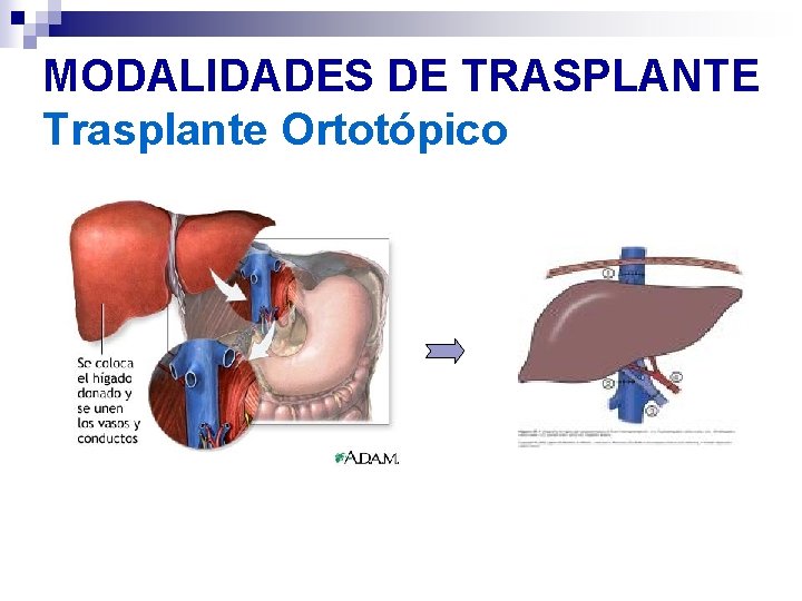 MODALIDADES DE TRASPLANTE Trasplante Ortotópico MODALIDADES DE TRASPLANTE Trasplante Ortotópico