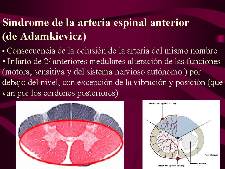 Síndrome de la arteria espinal anterior (de Adamkievicz) • Consecuencia de la oclusión de