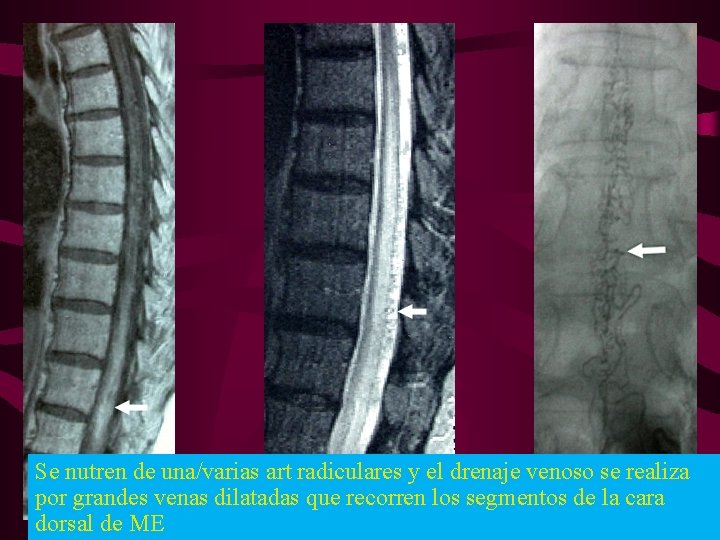 Se nutren de una/varias art radiculares y el drenaje venoso se realiza por grandes