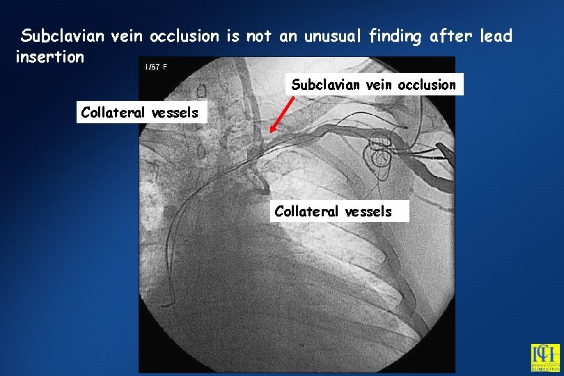 Subclavian vein occlusion is not an unusual finding after lead insertion Subclavian vein occlusion