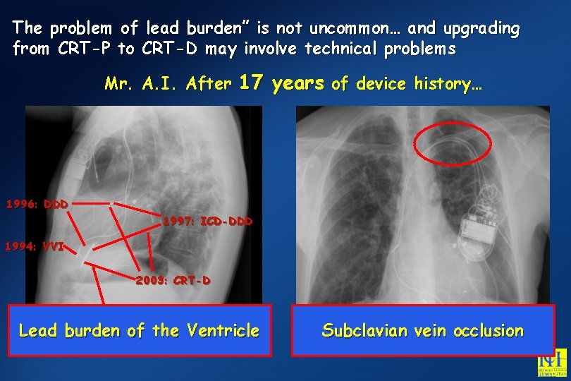 The problem of lead burden” is not uncommon… and upgrading from CRT-P to CRT-D