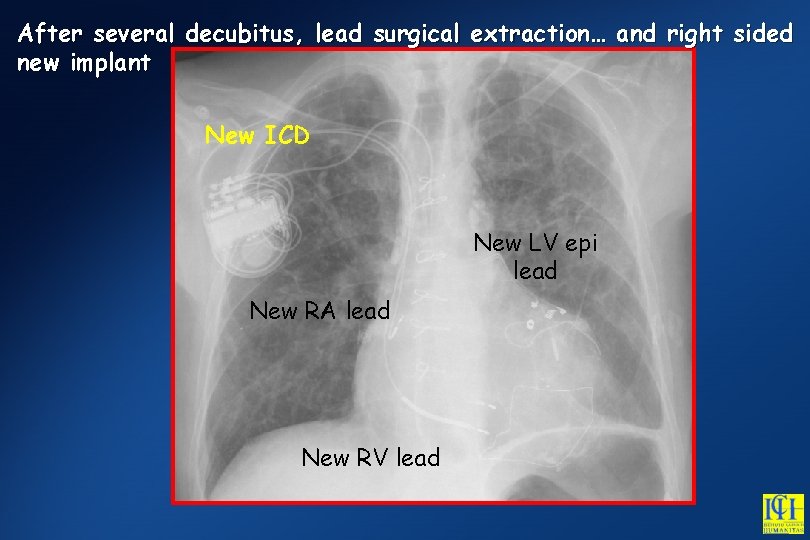 After several decubitus, lead surgical extraction… and right sided new implant New ICD New
