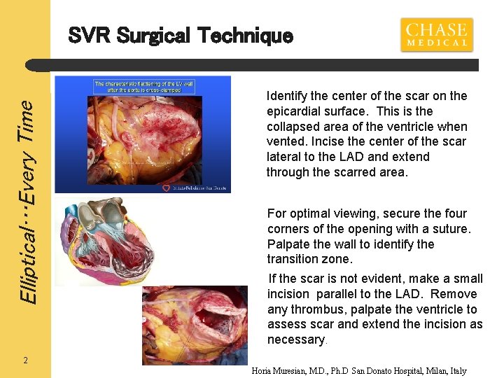 Elliptical…Every Time SVR Surgical Technique Identify the center of the scar on the epicardial