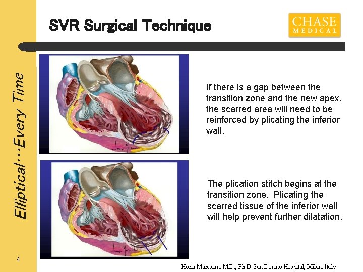 Elliptical…Every Time SVR Surgical Technique If there is a gap between the transition zone