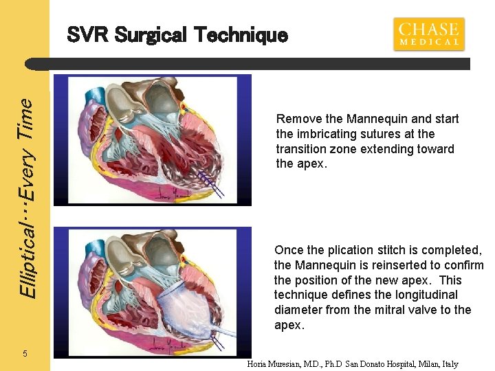 Elliptical…Every Time SVR Surgical Technique Remove the Mannequin and start the imbricating sutures at