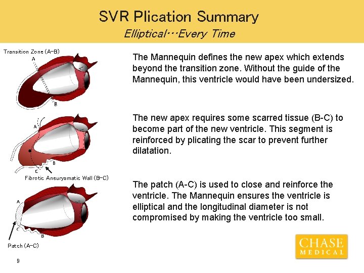 SVR Plication Summary Elliptical…Every Time Transition Zone (A-B) The Mannequin defines the new apex