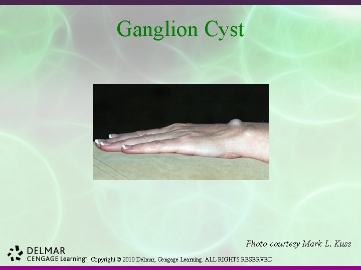 Ganglion Cyst Photo courtesy Mark L. Kuss Copyright © 2010 Delmar, Cengage Learning. ALL