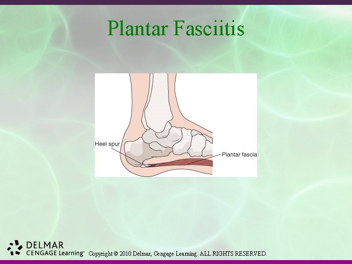 Plantar Fasciitis Copyright © 2010 Delmar, Cengage Learning. ALL RIGHTS RESERVED. 