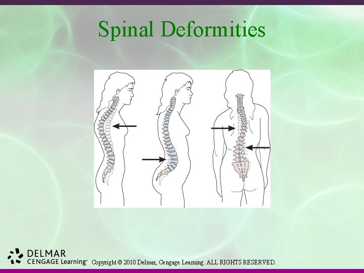 Spinal Deformities Copyright © 2010 Delmar, Cengage Learning. ALL RIGHTS RESERVED. 