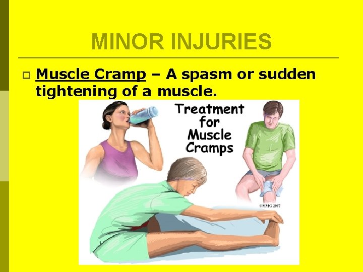 MINOR INJURIES p Muscle Cramp – A spasm or sudden tightening of a muscle. MINOR INJURIES p Muscle Cramp – A spasm or sudden tightening of a muscle.