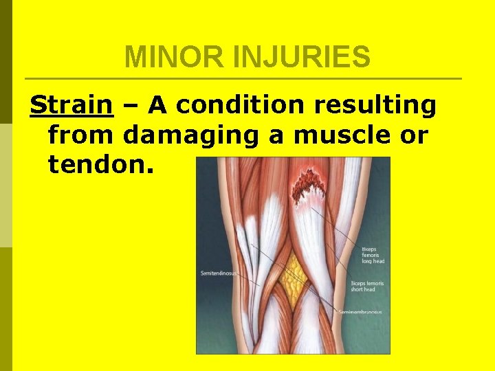 MINOR INJURIES Strain – A condition resulting from damaging a muscle or tendon. MINOR INJURIES Strain – A condition resulting from damaging a muscle or tendon.