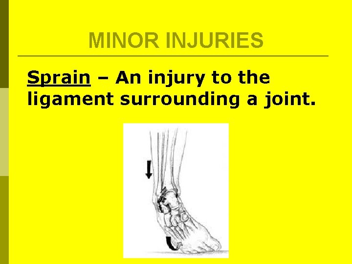 MINOR INJURIES Sprain – An injury to the ligament surrounding a joint. MINOR INJURIES Sprain – An injury to the ligament surrounding a joint.