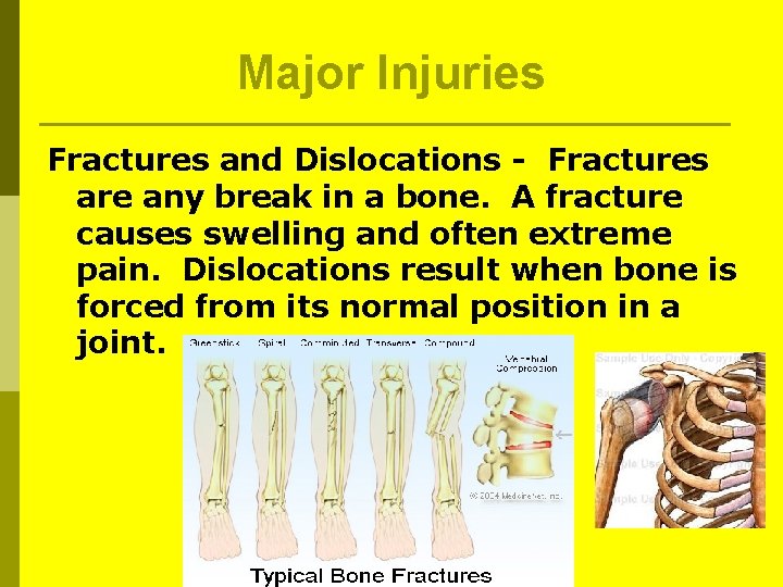 Major Injuries Fractures and Dislocations - Fractures are any break in a bone. A Major Injuries Fractures and Dislocations - Fractures are any break in a bone. A
