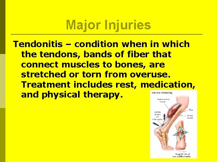 Major Injuries Tendonitis – condition when in which the tendons, bands of fiber that Major Injuries Tendonitis – condition when in which the tendons, bands of fiber that