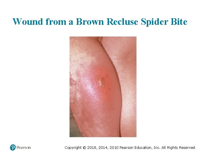 Wound from a Brown Recluse Spider Bite Copyright © 2018, 2014, 2010 Pearson Education,