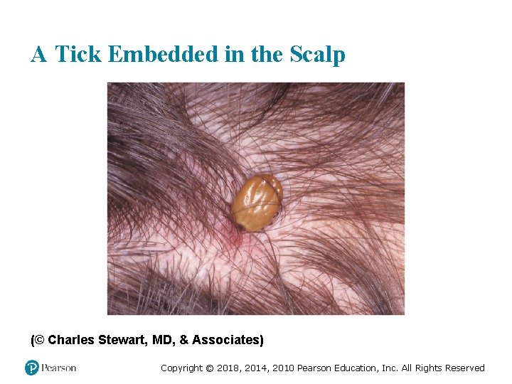 A Tick Embedded in the Scalp (© Charles Stewart, MD, & Associates) Copyright ©