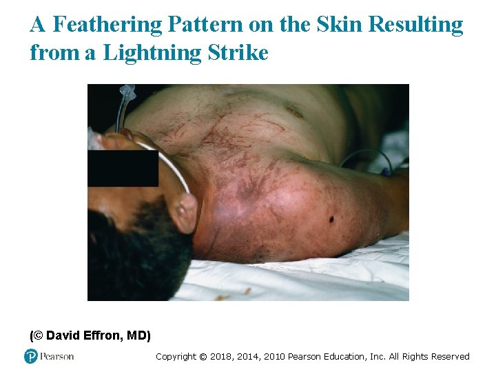 A Feathering Pattern on the Skin Resulting from a Lightning Strike (© David Effron,