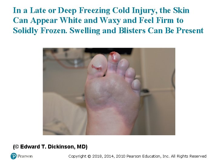 In a Late or Deep Freezing Cold Injury, the Skin Can Appear White and