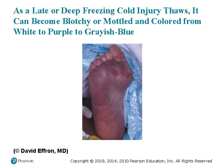 As a Late or Deep Freezing Cold Injury Thaws, It Can Become Blotchy or