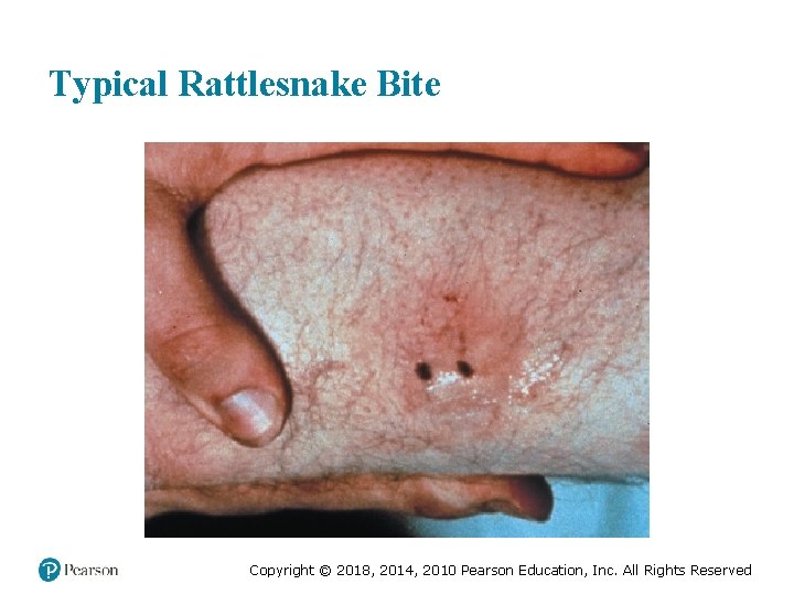 Typical Rattlesnake Bite Copyright © 2018, 2014, 2010 Pearson Education, Inc. All Rights Reserved