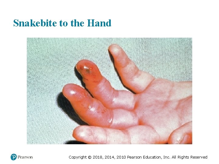 Snakebite to the Hand Copyright © 2018, 2014, 2010 Pearson Education, Inc. All Rights