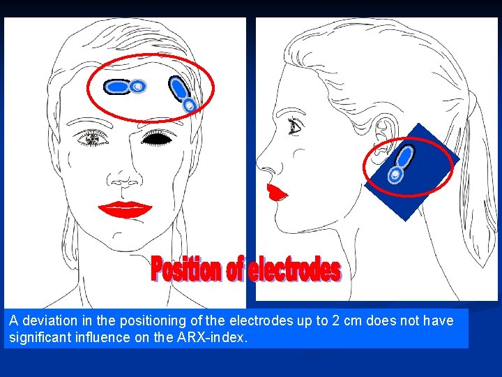 A deviation in the positioning of the electrodes up to 2 cm does not A deviation in the positioning of the electrodes up to 2 cm does not