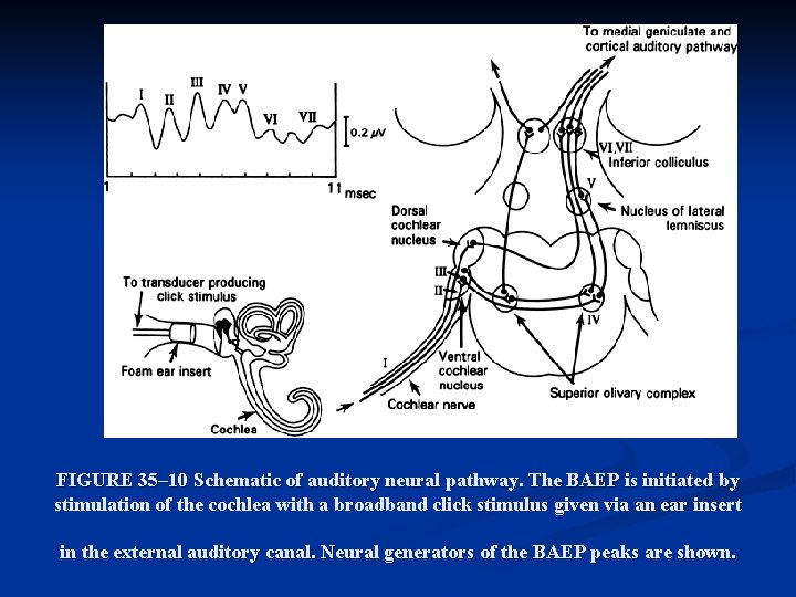 FIGURE 35– 10 Schematic of auditory neural pathway. The BAEP is initiated by stimulation FIGURE 35– 10 Schematic of auditory neural pathway. The BAEP is initiated by stimulation