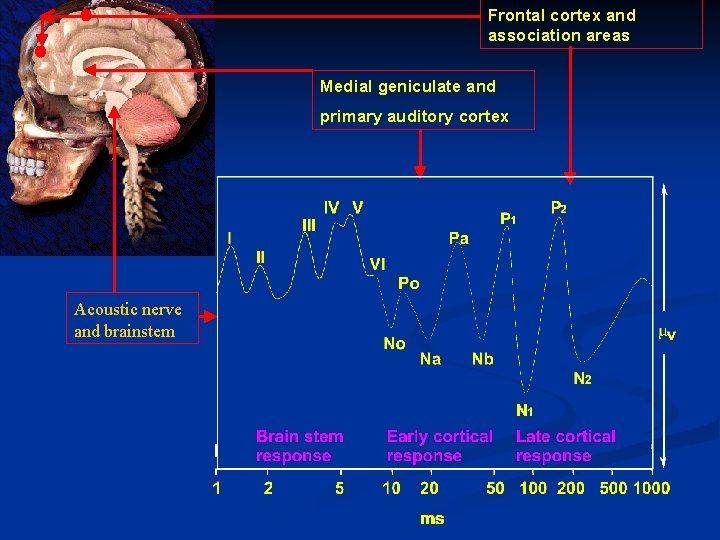Frontal cortex and association areas Medial geniculate and primary auditory cortex Acoustic nerve and Frontal cortex and association areas Medial geniculate and primary auditory cortex Acoustic nerve and