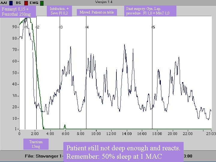 Fentanyl 0, 15 + Pentothal 250 mg Tracrium 15 mg Intubation. + Sevo FI Fentanyl 0, 15 + Pentothal 250 mg Tracrium 15 mg Intubation. + Sevo FI