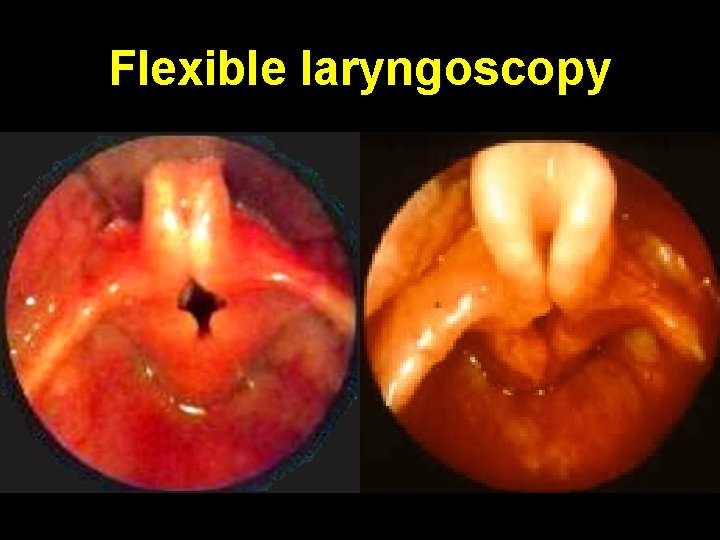 Flexible laryngoscopy 