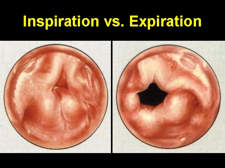 Inspiration vs. Expiration 