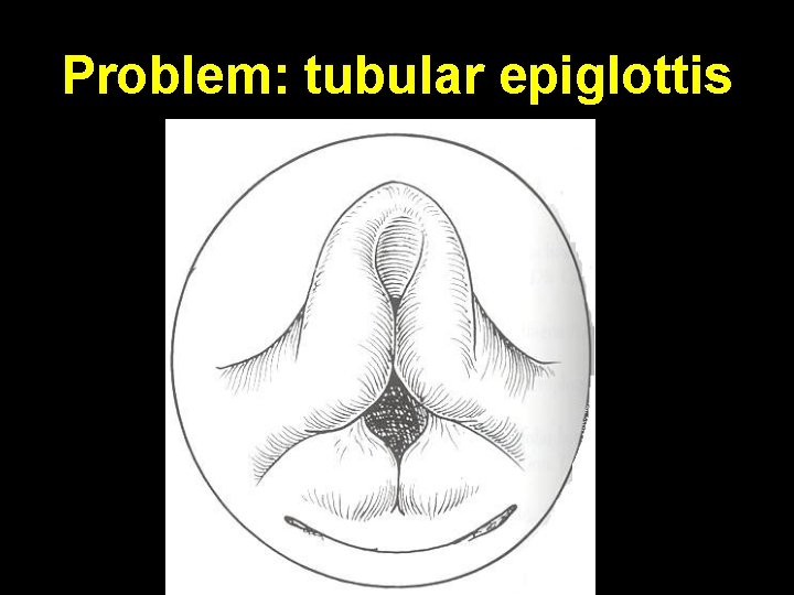 Problem: tubular epiglottis 