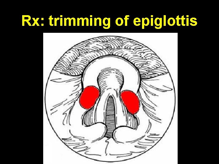 Rx: trimming of epiglottis 