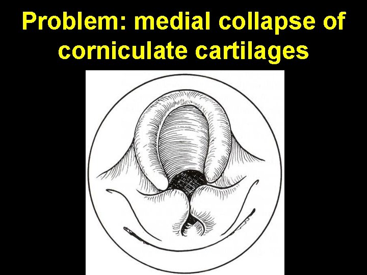 Problem: medial collapse of corniculate cartilages 