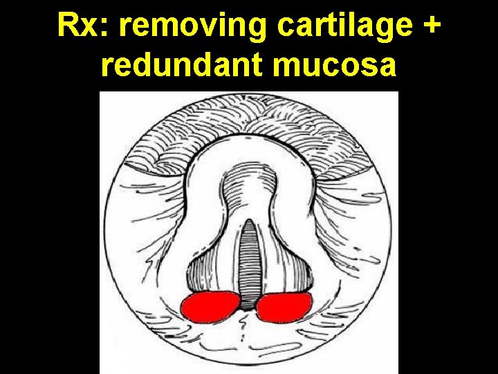 Rx: removing cartilage + redundant mucosa 