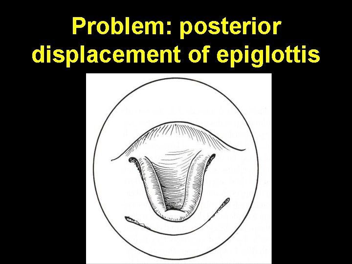 Problem: posterior displacement of epiglottis 