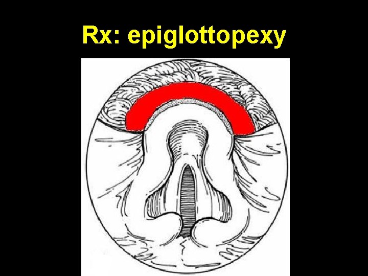 Rx: epiglottopexy 