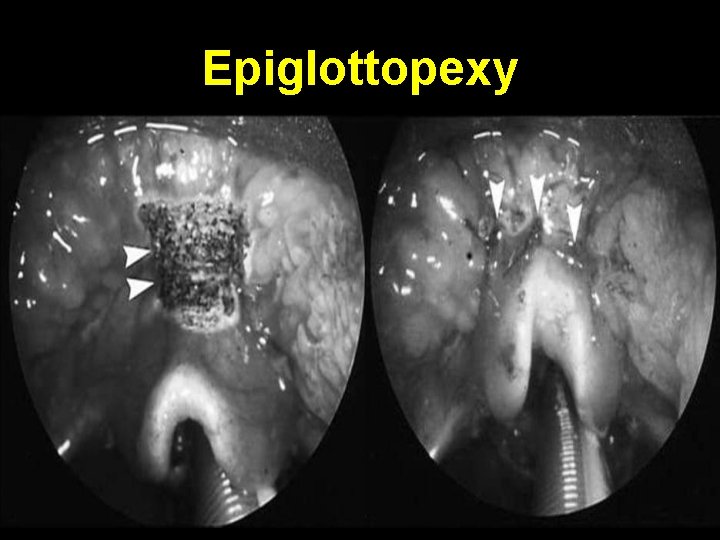 Epiglottopexy 