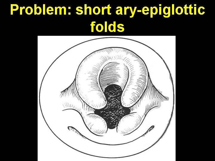 Problem: short ary-epiglottic folds 