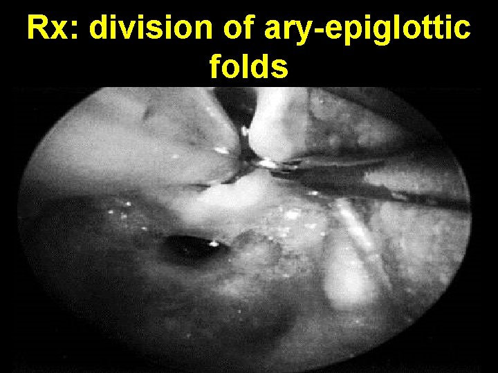 Rx: division of ary-epiglottic folds 